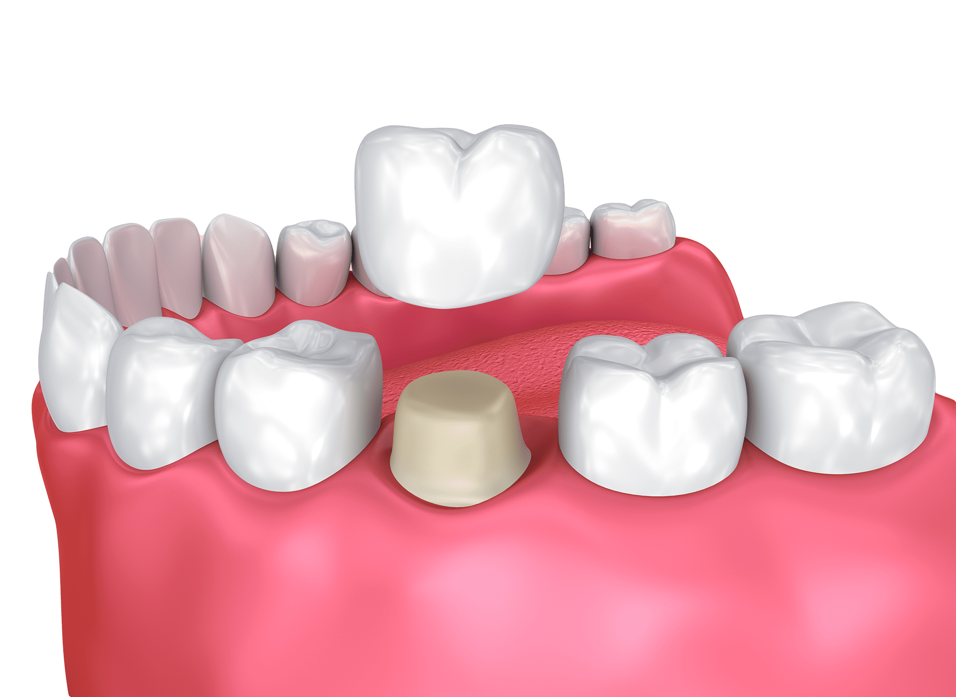 Dental Crowns In Saraland AL
