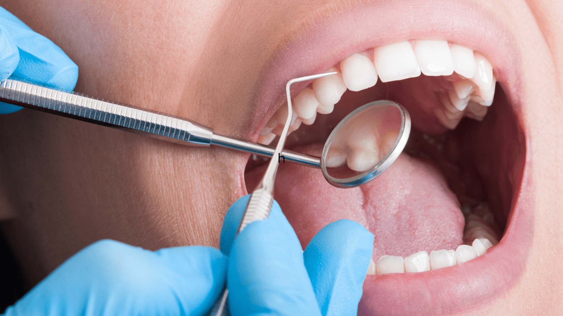 Saraland Dentist Looking at Teeth - Teeth Cleaning